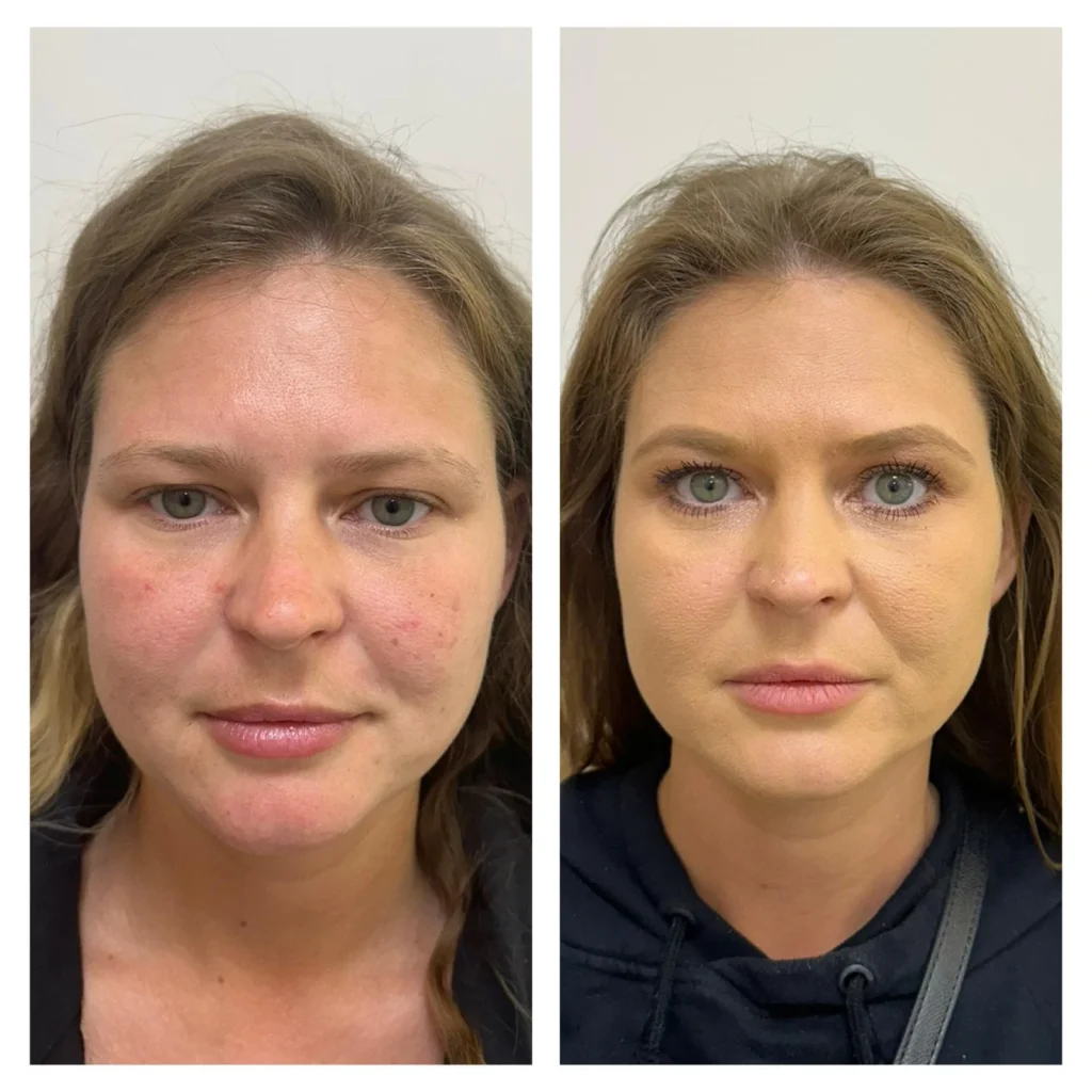 Endo laser cheeks and face tigthening