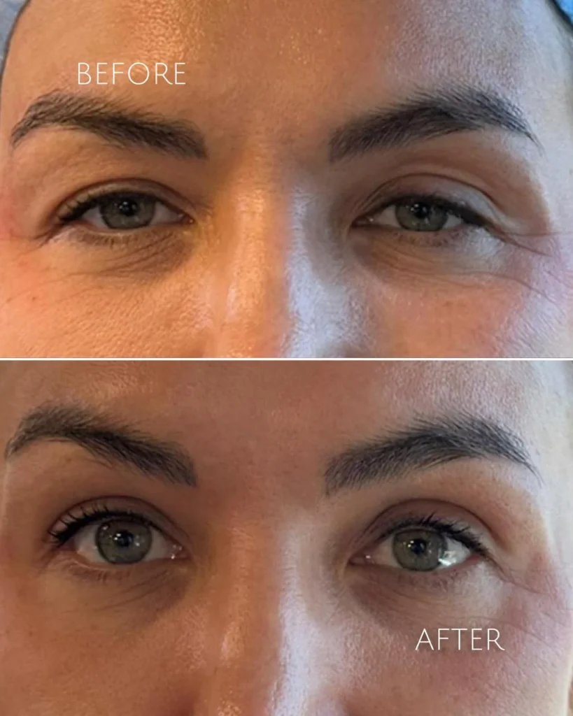 Endo laser eye lift