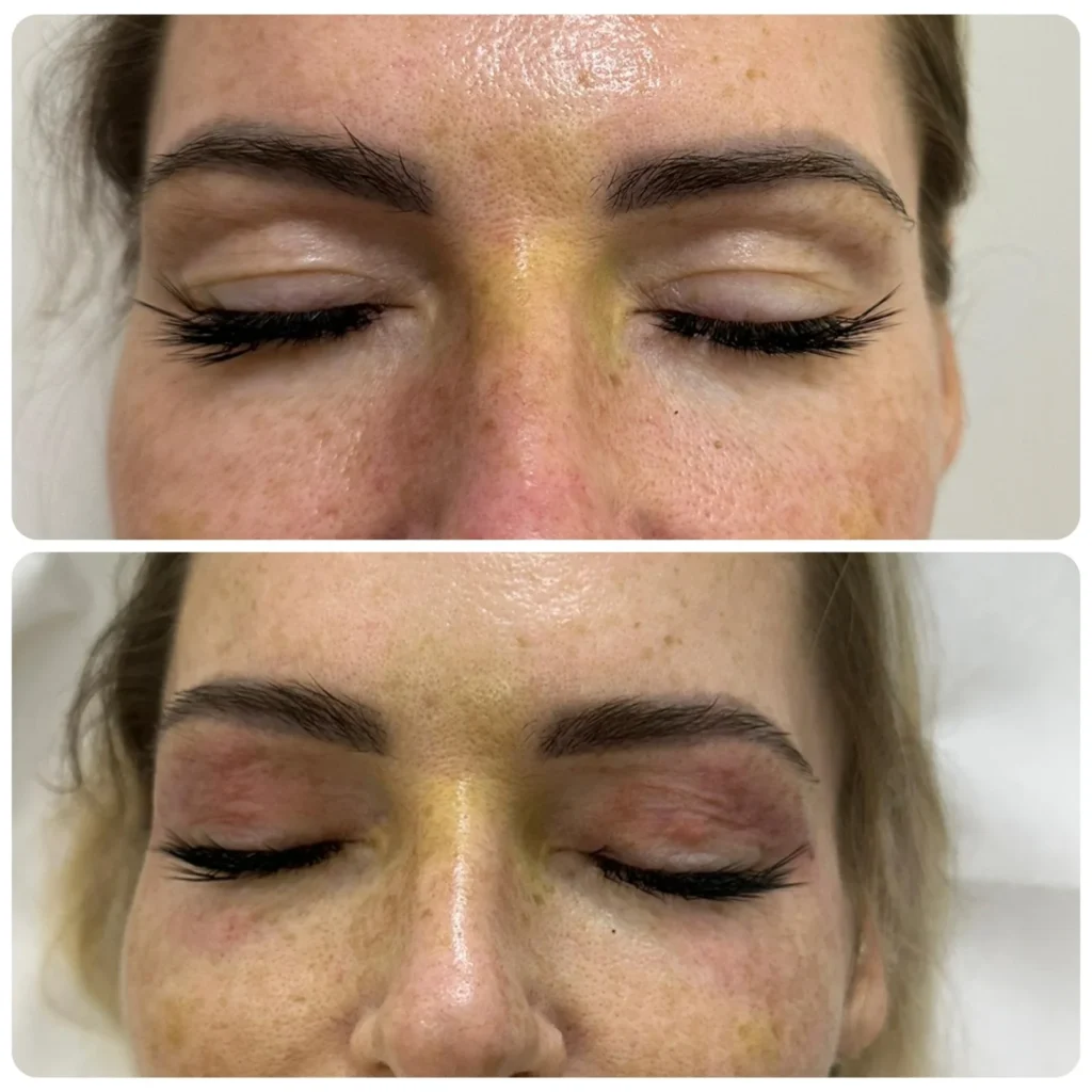 Endo laser eyelids tightening