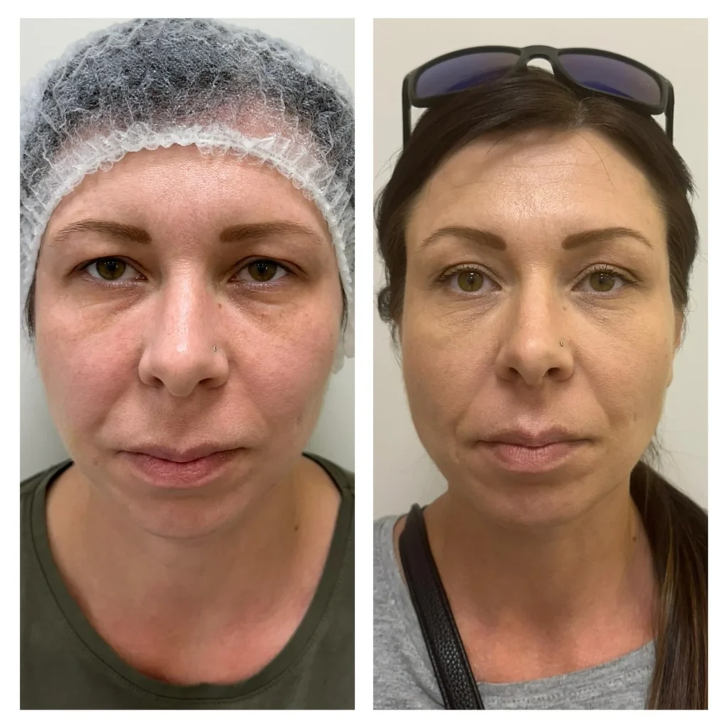 Endo laser face lift looking younger naturally