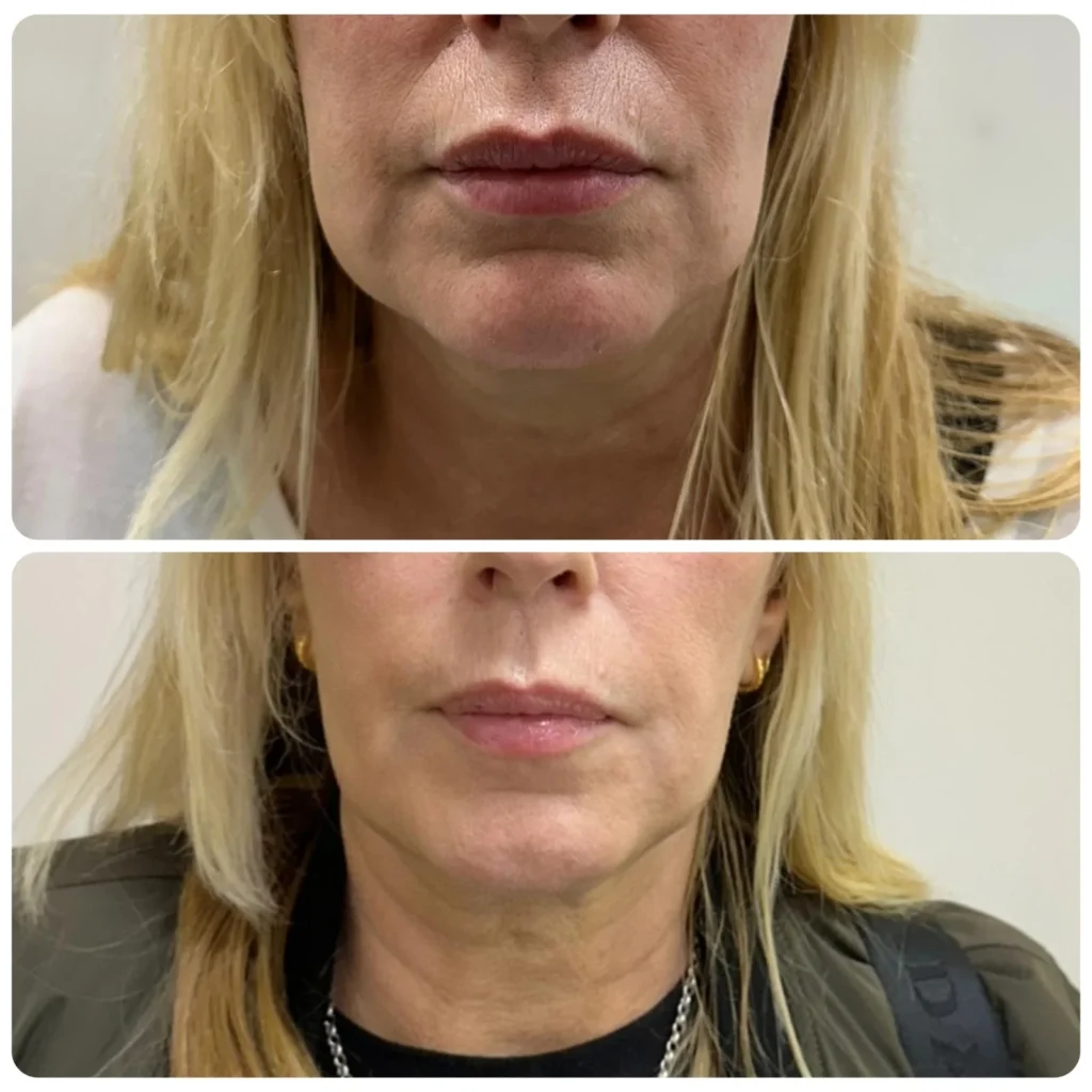 Endo laser lower face skin tightening, chin, mouth and cheeks
