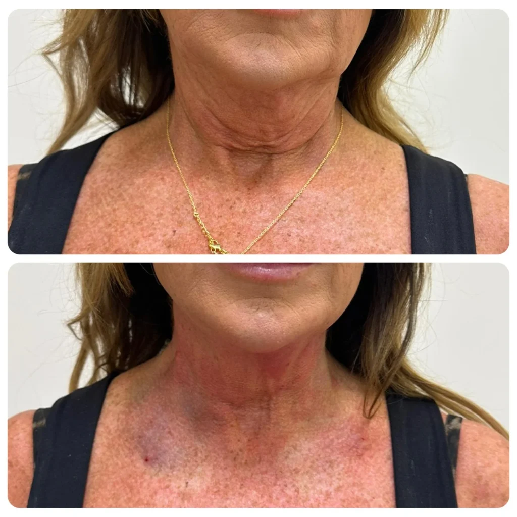 Endo laser neck saggy skin tigthening