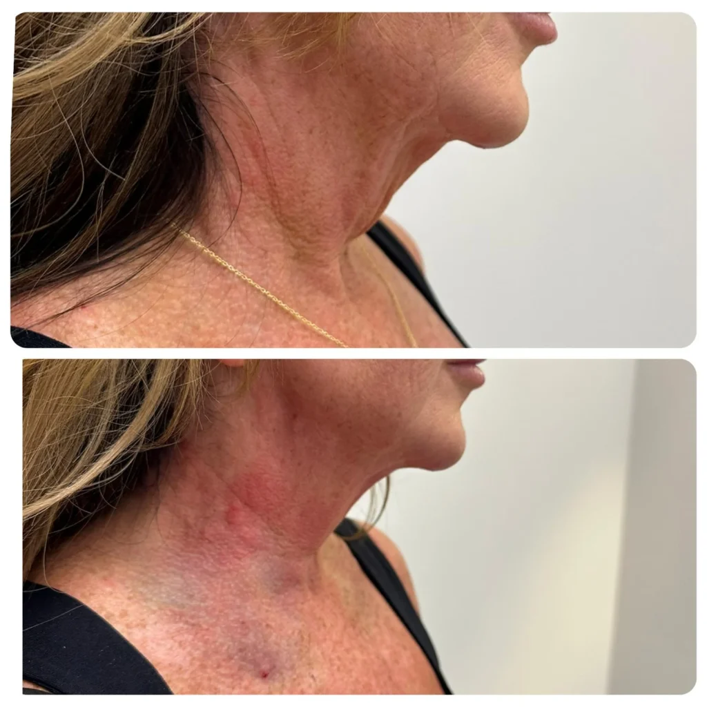 Side profile of neck sagging skin angle