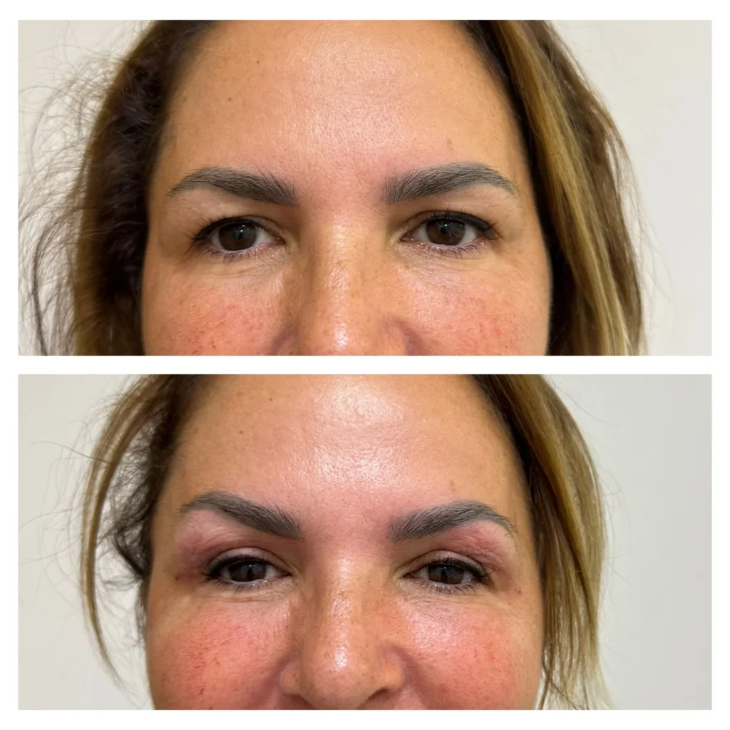 Endo laser skin tightening eye lids